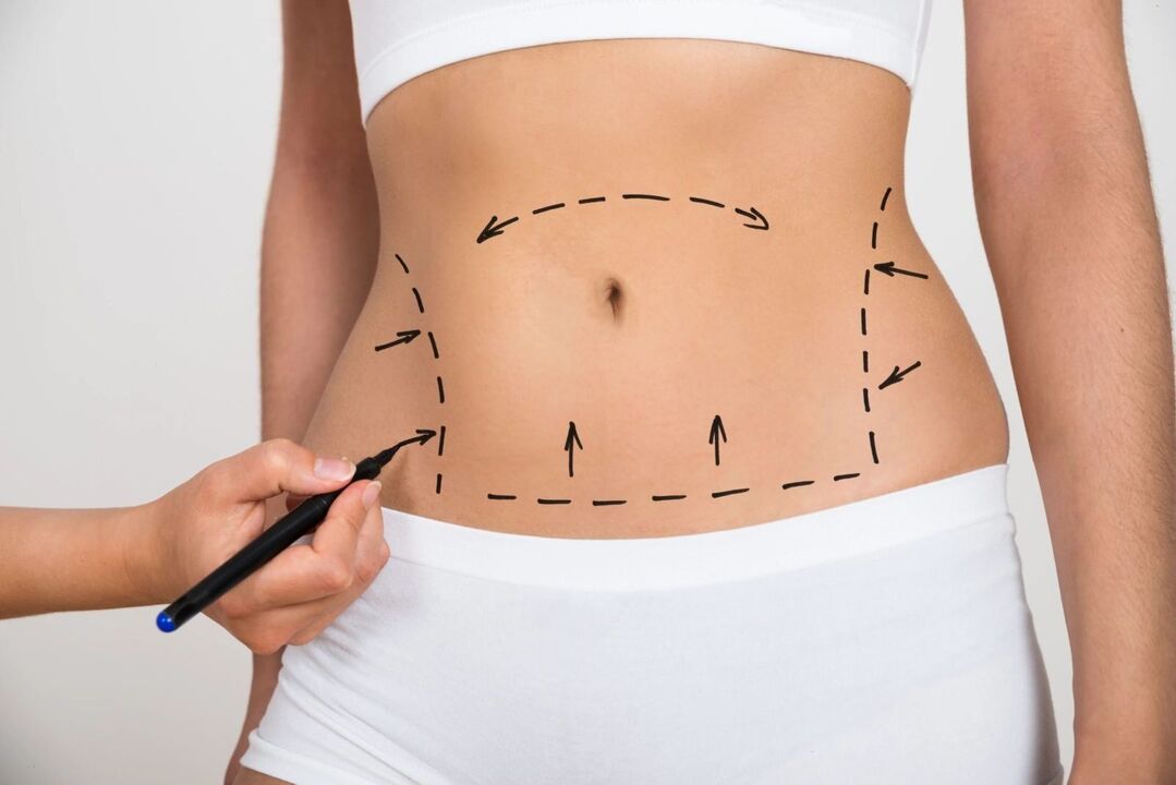 Marking on the abdomen before liposuction, correction of the silhouette